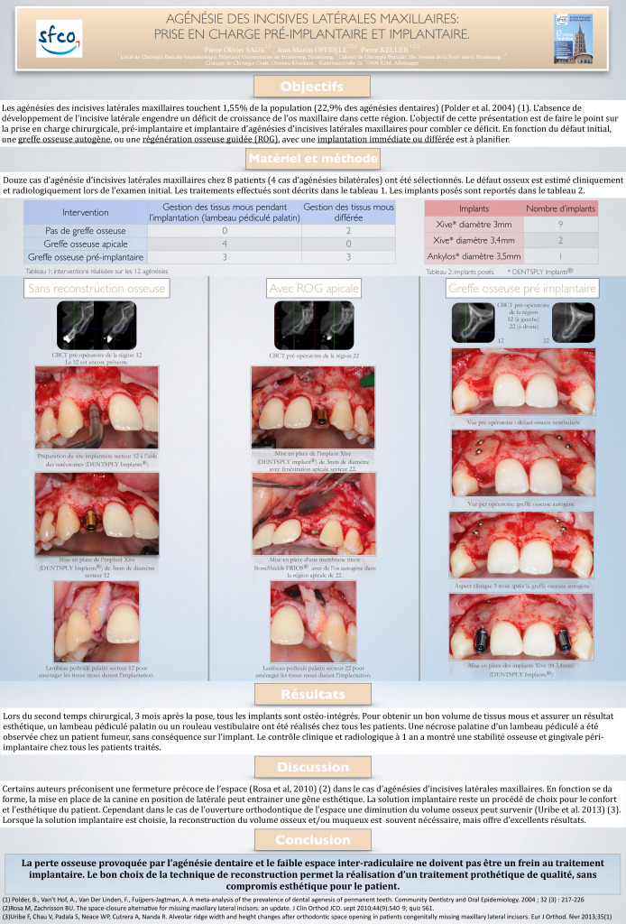 thumbnail of Agénésie des incisives latérales maxillaires