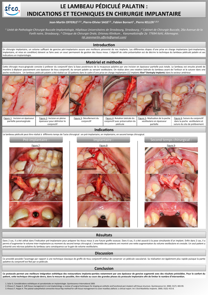 thumbnail of Le lambeau pédiculé palatin indications et techniques